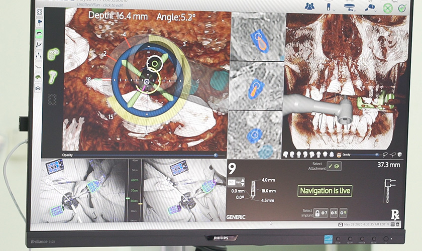 Navigation Technology in Dental Implant