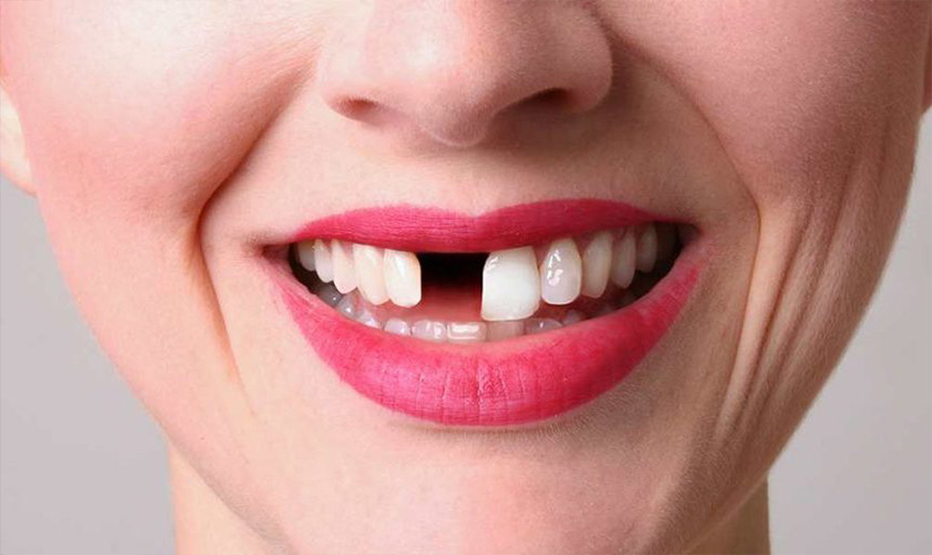 Dental implant to replace a missing tooth