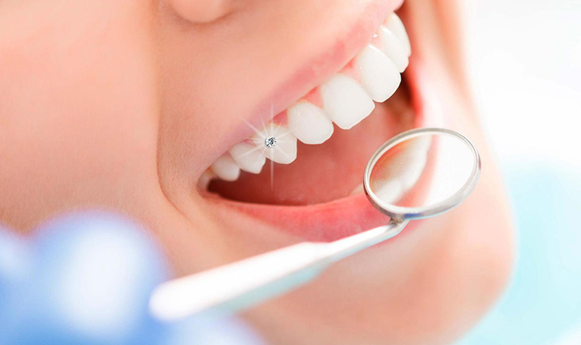 Denture: Common misconceptions