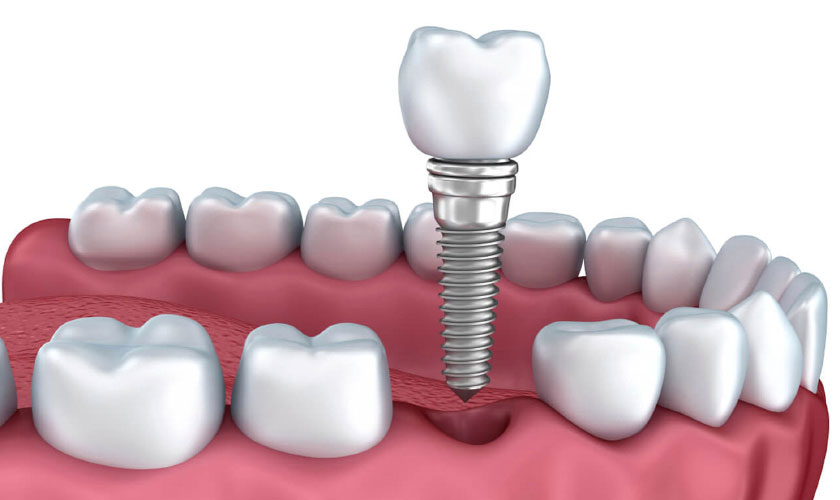 Cấy ghép răng Implant