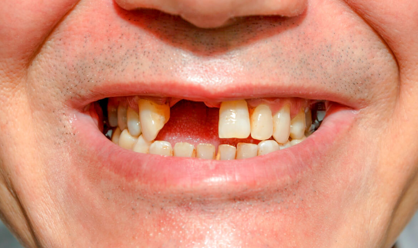 Broken incisors and effective recovery solution