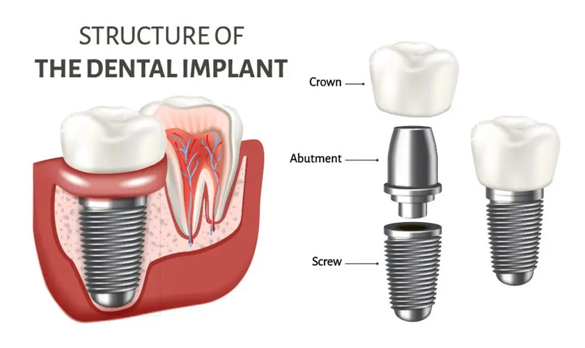 Dental implant placement