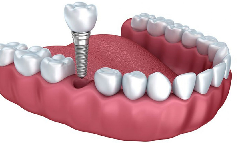 How much do dental implants cost?