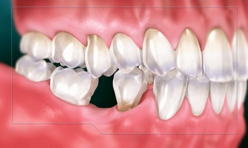 How much does a lower jaw implant cost?