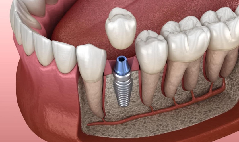 Hình: How much is a dental implant? Is it safe?	