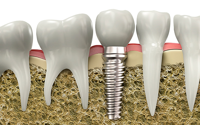 How to prepare for dental implant surgery?