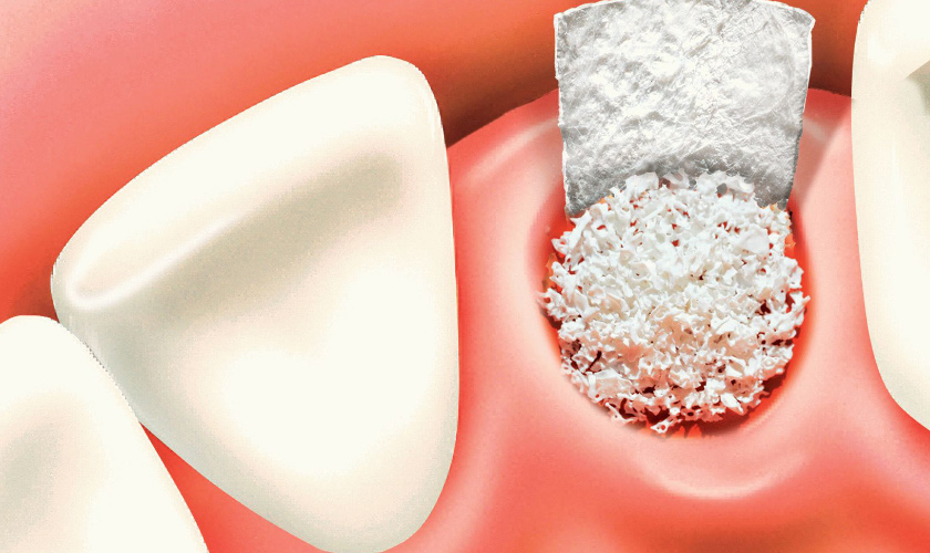 Iliac crest bone graft and dental implant placement