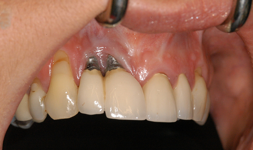 Implant placement after extraction