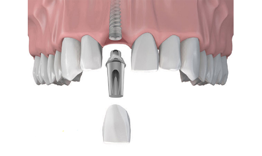 Implant placement after extraction