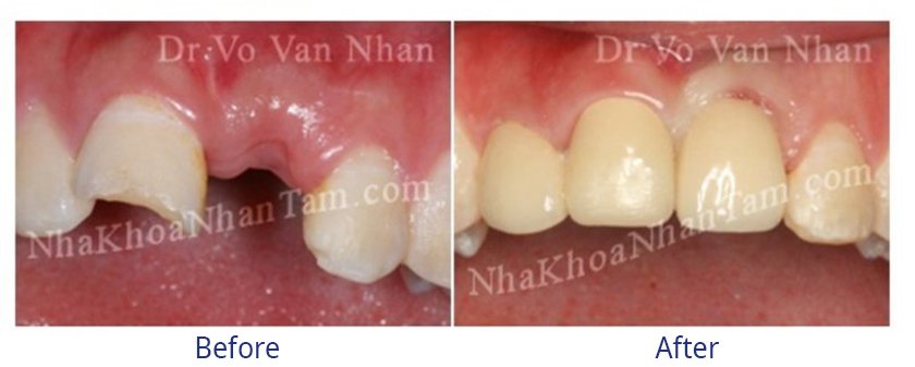 Implant placement after extraction