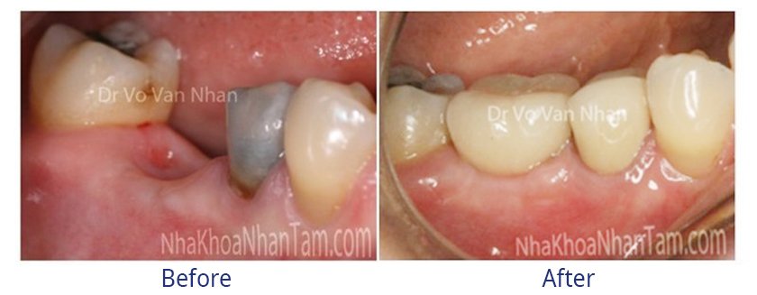 Implant placement after extraction