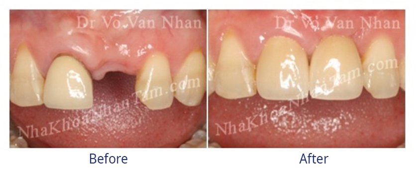 Implant placement after extraction