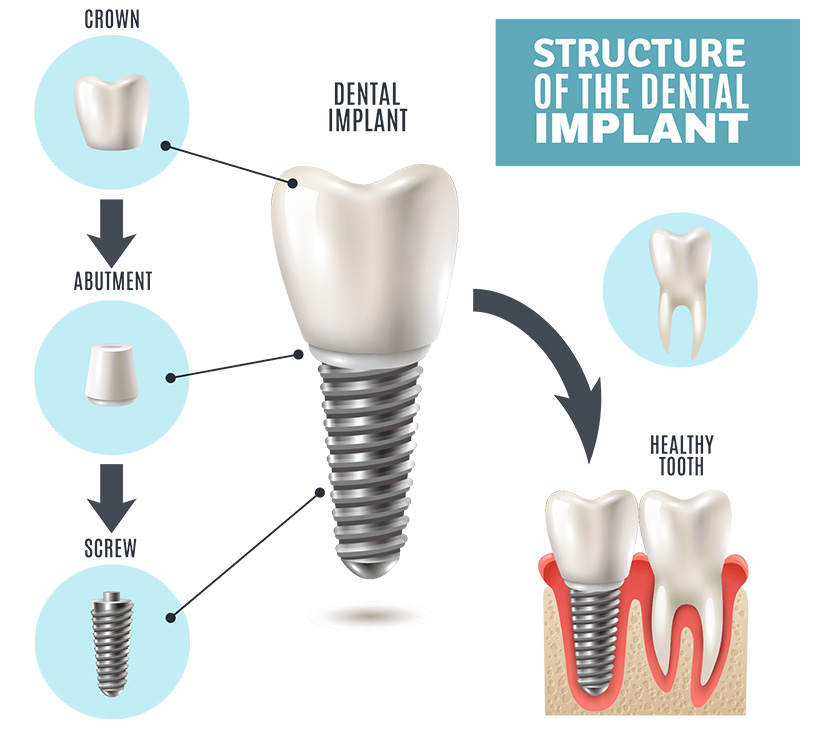 Comparison (Real tooth/implanted tooth)