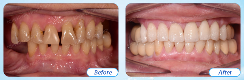 Customers' impression after experiencing implant services at Nhan Tam Dental