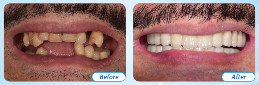 Customers' impression after experiencing implant services at Nhan Tam Dental