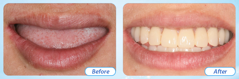 Customers' impression after experiencing implant services at Nhan Tam Dental