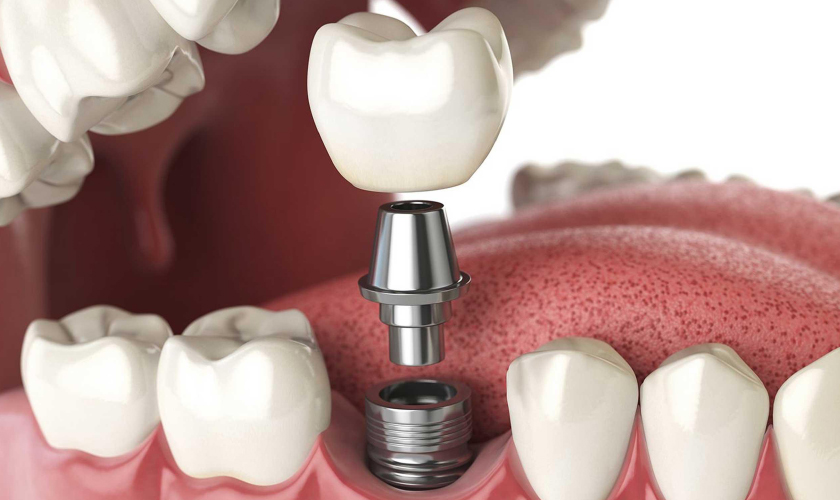 Implant placement at Nhan Tam Dental