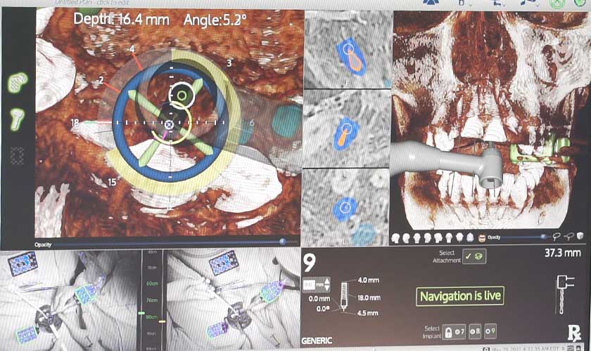 A tracker camera allows doctors to visualize in real-time implant sites, therefore ensure the absolute accuracy of the implant surgery