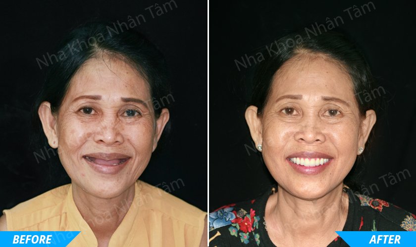 Dental implant bring strong teeth and beautiful smiles to patients