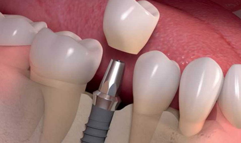 Restoring the crown is the last step to complete the procedure