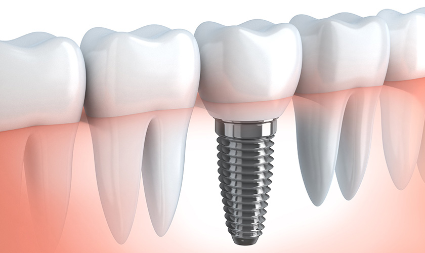Dental Implant Placement