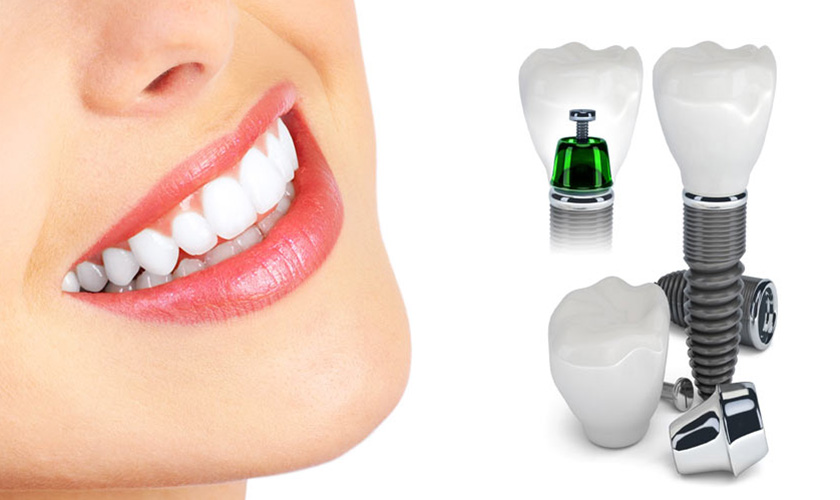 Implant teeth in cosmetic zone: not easy at all!