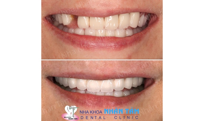 Kỹ thuật Implant All on 4