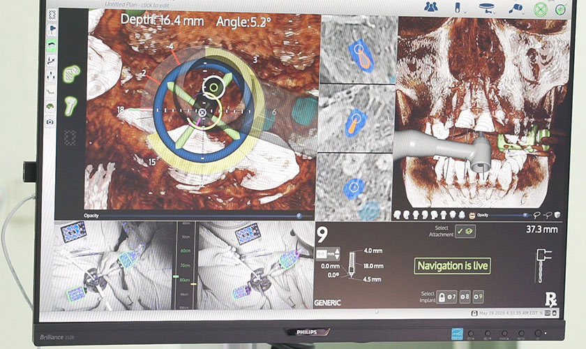 Kỹ thuật Implant All on 4