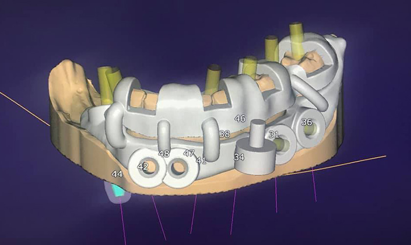 Kỹ thuật Implant All on 4