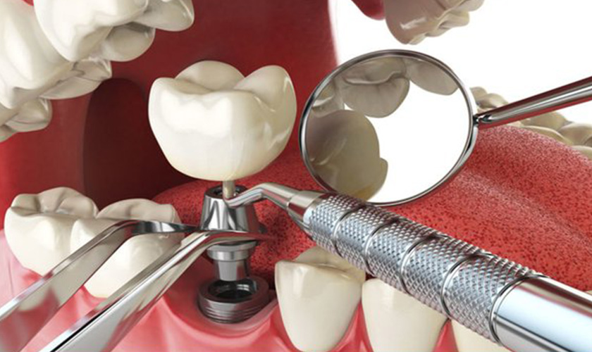 Painless dental implant procedure at Nhan Tam Dental