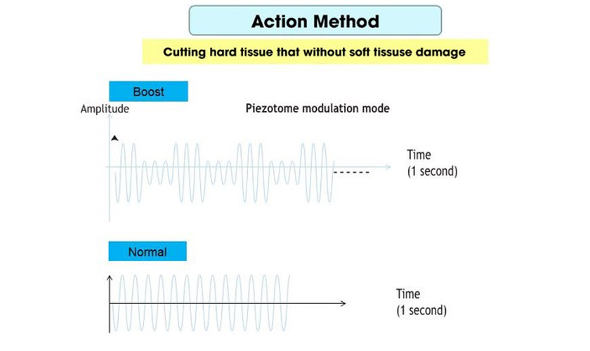 Flexible ultrasound waves provide comfort for the patient