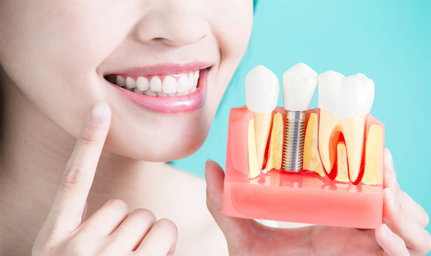 Cấy ghép Implant cho chức năng ăn nhai tốt hơn