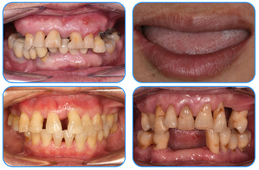 Cases that should have dental implants