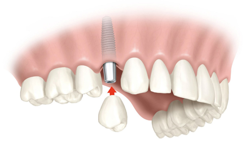 Implanting one fixture on one jaw