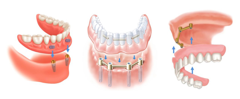 Removable denture on 2 - 4 implant fixtures