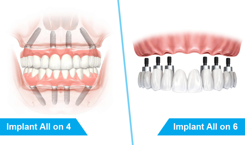All-on-6 and All-on-4 dental implants