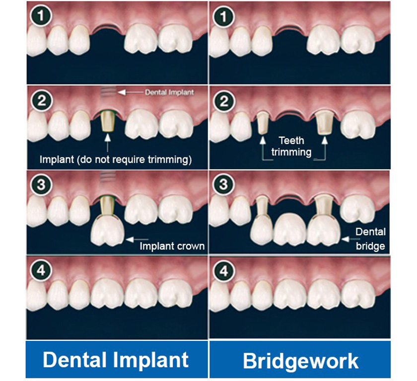 Implants are completely independent, no need for support from the surrounding teeth