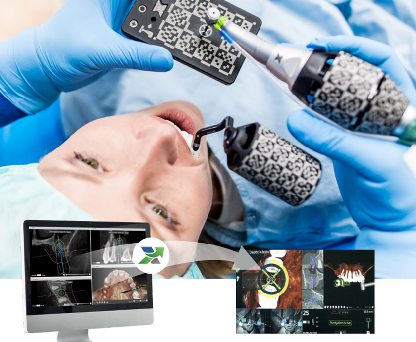 Dental implant navigation system brings a lot of benefits to patients