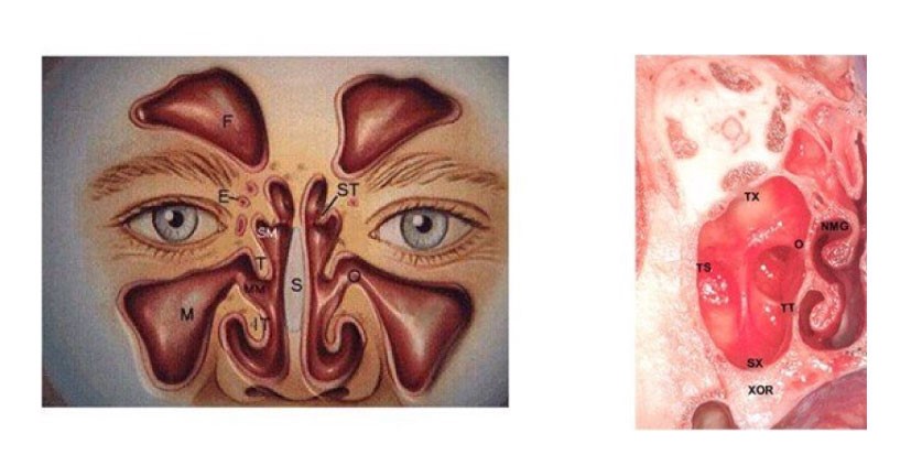 Figure 3 Standing through the sinus cavity [11] Figure 4: Vertical line through the sinus cavity [2]