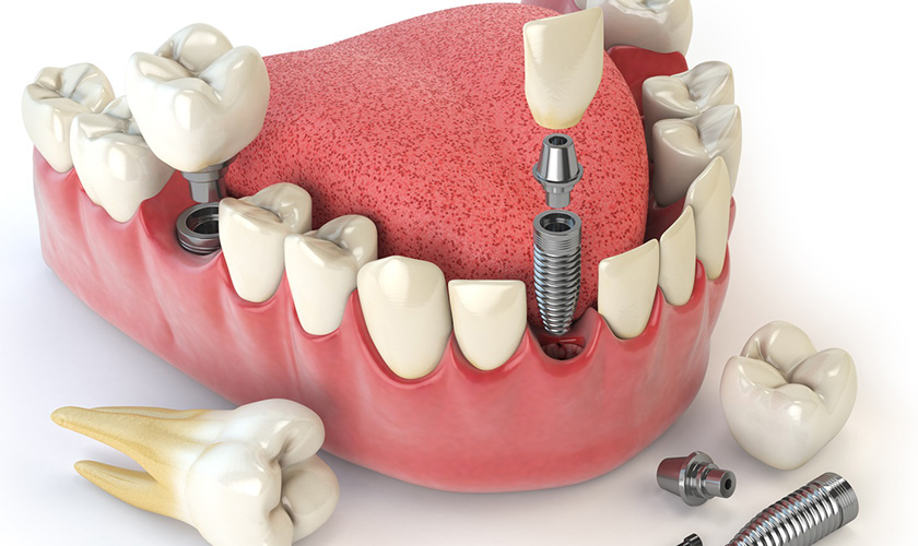 Dental implant method