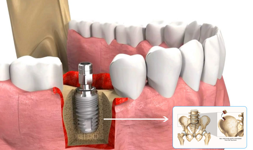 Autologous bone graft