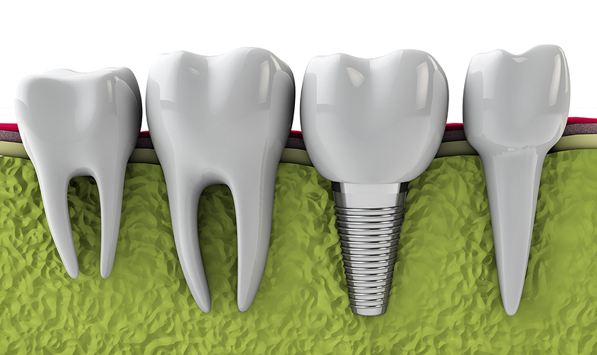 Advantages of Dental Implants