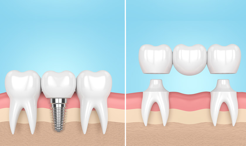 Missing teeth – Why should I choose dental implant instead of dental bridge?