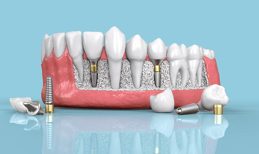 Hình: Why should you have dental implants?