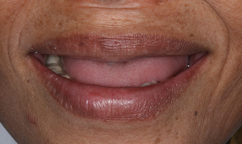 The condition of Ms. Ngoc Linh's teeth before surgery