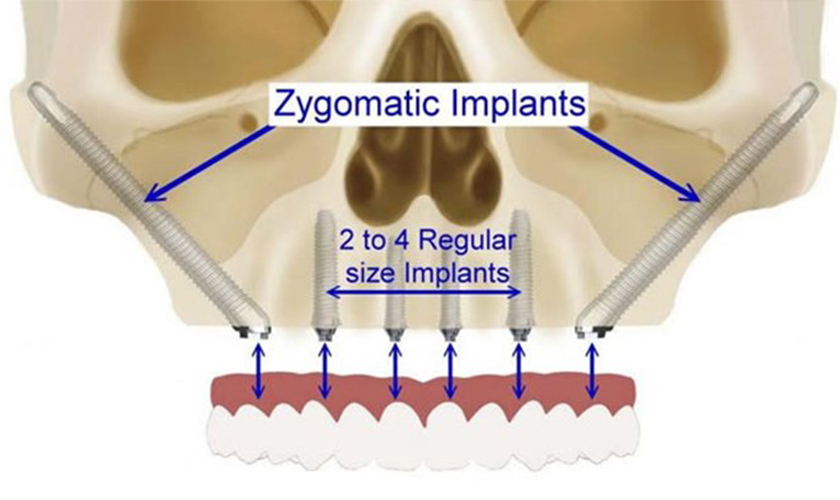Zygomatic Implant Placement