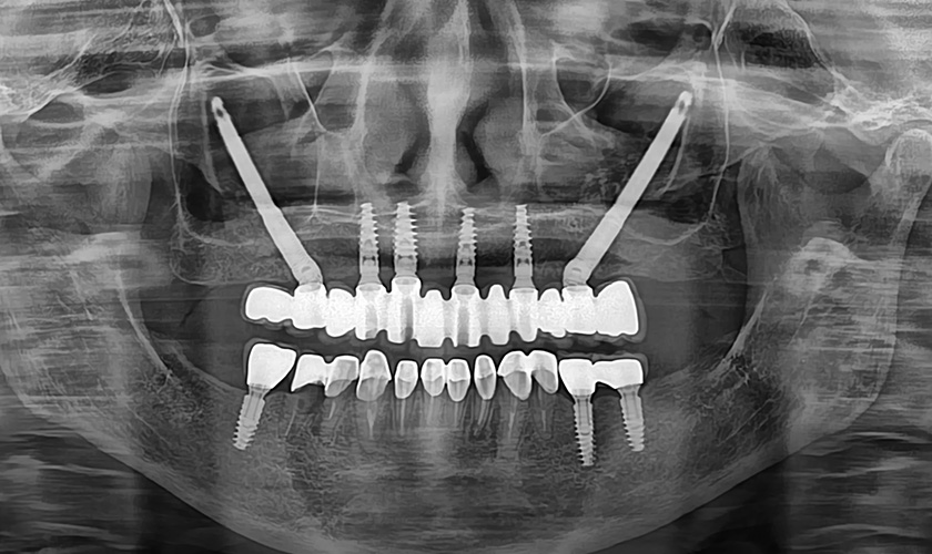 CT scan image of 2 zygomatic implants and 4 standard dental implants in the anterior maxilla