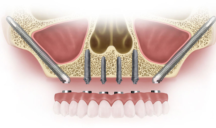 An Advance In Implant Dentistry In Vietnam: Zygomatic Implant Placement