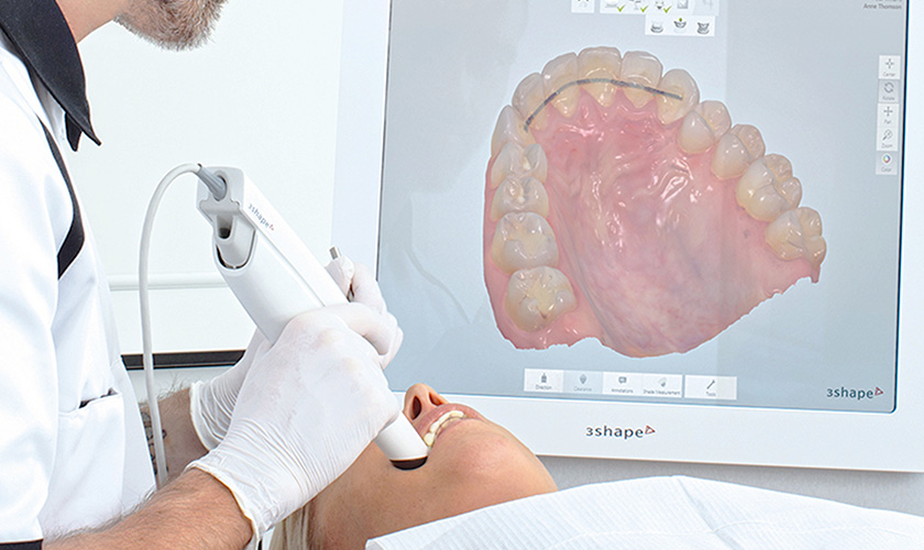 Digital dental impression by 3Shape 3D