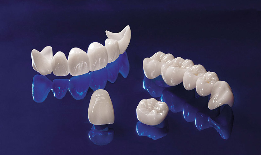 All-ceramic porcelain Emax guarantees superior aesthetics and strength